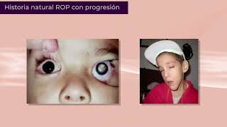 Retinopatía del Prematuro Video ROP 2022 Español [upl. by Aleedis]