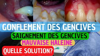 Pourquoi Vos Gencives Saignent  Causes Prévention et Traitement de la Gingivite [upl. by Goggin94]