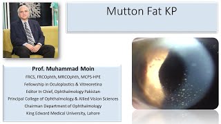 Mutton Fat Keratic Precipitates [upl. by Jessika]