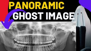 Panoramic Radiographs Ghost image Principles of Panaromic Radiography OPG Focal trough [upl. by Isabea]