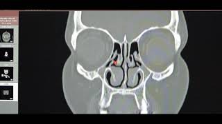 When to Operate for FESS in Chronic Bilateral Pansinusitis with Neoosteogenesis CT PNS Basics [upl. by Acsot494]