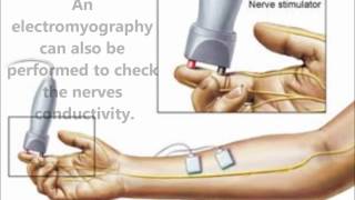 GuillainBarre Syndromewmv [upl. by Alli]