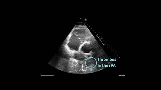 〖Echocardiography〗 Acute pulmonary embolism with a thrombus in the right pulmonary artery 🏥 [upl. by Kinsman]