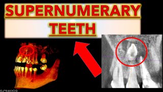 How to Make Sure it is a Supernumerary Tooth Extra teeth in mouth hyperdontia extra front teeth [upl. by Purity]