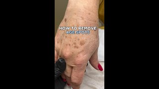 How to remove AGE SPOTS [upl. by Osana]