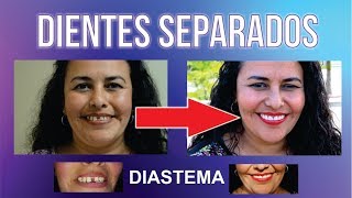 RESTAURACIÓN dental con resina  Video 3D paso a paso [upl. by Devona]