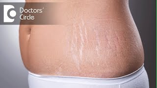 Laser treatments for stretch marks after delivery  Dr K Prem Anand [upl. by Malachy949]