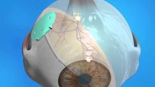 Glaucoma Drainage Implant [upl. by Dasi]