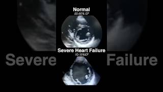 Echocardiogram NORMAL vs SEVERE HEART FAILURE radiology cardiology [upl. by Yoc988]