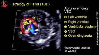 Fetal echocardiography at 1113 weeks Tetralogy of Fallot TOF [upl. by Niahs]