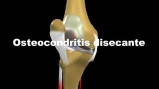 Osteocondritis Disecante [upl. by Thorsten]