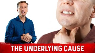 Burning Throat Syndrome or Silent Acid Reflux Causes – DrBerg [upl. by Hana]