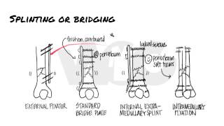 Principles of Fracture Fixation  Orthopedic Basics [upl. by Emmaline238]