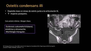 Radiología en 5 minutos Osteitis Condensans Illi [upl. by Llohcin]