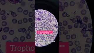 MP slide Plasmodium vivax on oil immersion 100× laboratory hematology [upl. by Thetos]