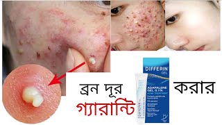 রাতে এই জেল লাগান সকালে ব্রন গায়েব হয়ে যাবে Differin Adapalene Gel  khadija begum  acne treatment [upl. by Helbonna65]