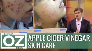 The Latest Apple Cider Vinegar Trend [upl. by Gosnell667]