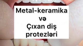 Metal keramika və çıxan diş protezləri [upl. by Maiga757]