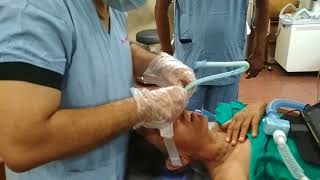 Video assisted Nasal Intubation [upl. by Osnola]