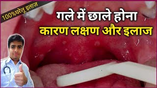 गले और मुंह के छालों का घरेलु इलाज  Home Remedies for Mouth Ulcers  Throat Ulcer Treatment [upl. by Roid]