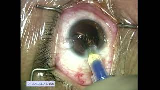 FINEVISION POD F implantation by Dr Chan [upl. by Weissberg]