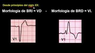 CURSO DE ELECTROCARDIOGRAFIA 48  EXTRASÍSTOLES VENTRICULARES [upl. by Riatsala]