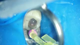 Retrieval Of OverExtended GuttaPercha Under The Microscopic Magnification Dr  Mustafa Kabbani [upl. by Sandro902]