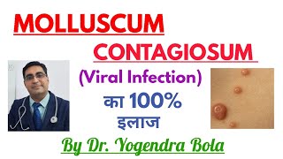 Molluscum Contagiosum ka 100 Treatment [upl. by Tareyn]