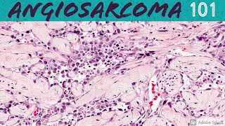 Angiosarcoma 101 for Pathologists and Dermatologists [upl. by Ricoriki]