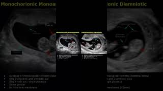 30 Weeks Twin  Boy Girl   Monochorionic Diamniotic Pregnancy  Ultrasound [upl. by Nemajneb926]