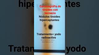 Tiroglobulina alta y cáncer diferenciado de tiroides [upl. by Ameyn513]