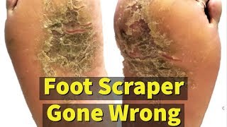 Foot Scraper Gone Wrong [upl. by Timmi285]