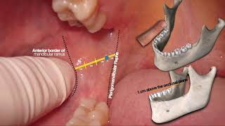 Inferior alveolar nerve block amp Live demo بشرح مفصل [upl. by Cristobal367]