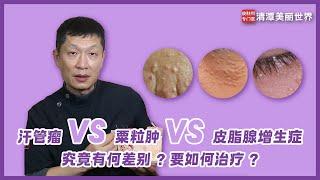 汗管瘤VS栗粒肿VS皮脂腺增生症究竟有何差别？要如何治疗 syringoma chinese subtitles [upl. by Ynnattirb912]