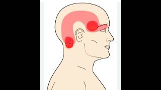 headache physiotherapy treatments physiotherapy rehabilitation painrelief [upl. by Assyram]