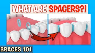 BRACES 101 Spacers For Braces  Treatment Minute Talk [upl. by Atinaej131]