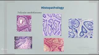 Omneya Wahba Odontogenic Tumors 1 [upl. by Dahsraf]