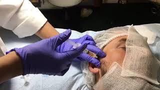 PRP Treatment for TMJ temporomandibular [upl. by Arocahs]