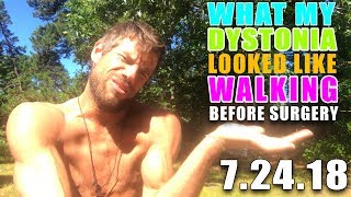 9 Days Prior to Surgery  What Walking wDystonia Looked Like [upl. by Orvah]