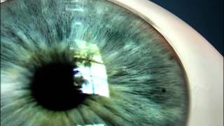 Laser Iridotomy for Angle Closure Glaucoma [upl. by Meade]