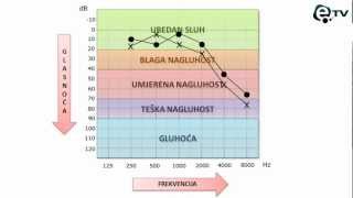 Kako pročitati audiogram [upl. by Olimac]