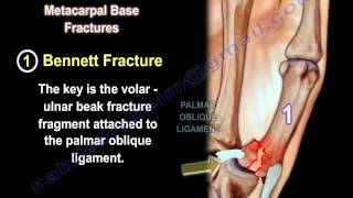 Thumb Metacarpal Base Fracture Injury  Everything You Need To Know  Dr Nabil Ebraheim [upl. by Nicoline831]