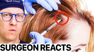 Surgeon Reacts I Tried PRP For Hair Restoration [upl. by Montgomery]