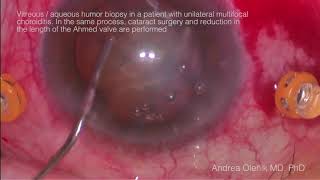 Vitreous aqueous humor biopsy in a patient with unilateral multifocal choroiditis In the same pro [upl. by Hoon448]