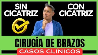 ⚠️ CIRUGÍA DE BRAZOS SIN CICATRIZ ¡CASOS CLÍNICOS ► Resultados Antes y Después Técnica Five Stars [upl. by Mauri707]