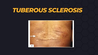 Tuberous Sclerosis [upl. by Eveiveneg]