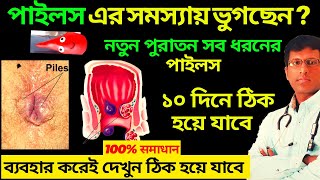 Say goodbye to piles  Piles treatment without surgery  অর্শ   Piles treatment homeopathic [upl. by O'Connell886]