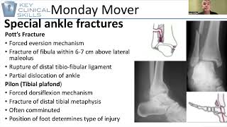 Less Common Ankles Fractures [upl. by Banky]