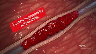 DClot HD Mechanical Thrombectomy System [upl. by Yetak85]