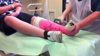 broken foot cast removal [upl. by Naggem]